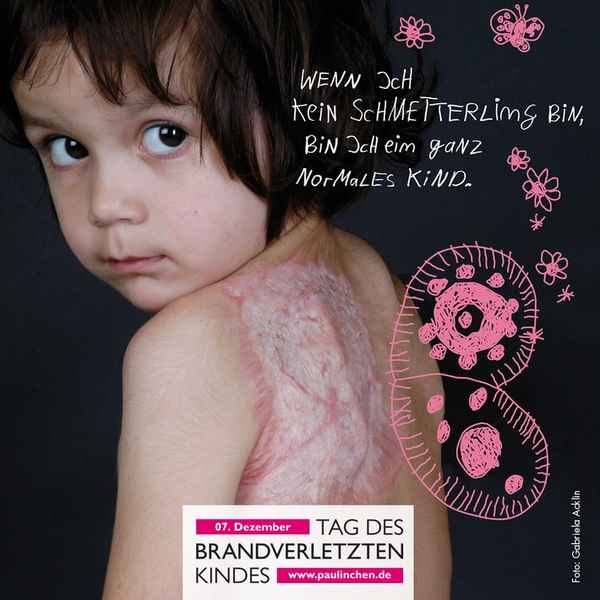 FW Weinheim: Tag des brandverletzten Kindes Gemeinsam Kraft geben, Prävention stärken