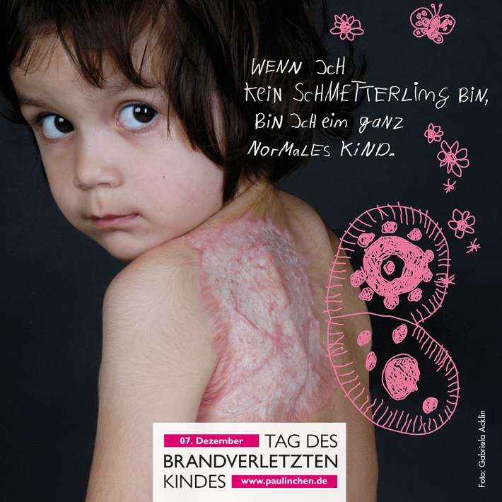 FW Weinheim: Tag des brandverletzten Kindes Gemeinsam Kraft geben, Prävention stärken